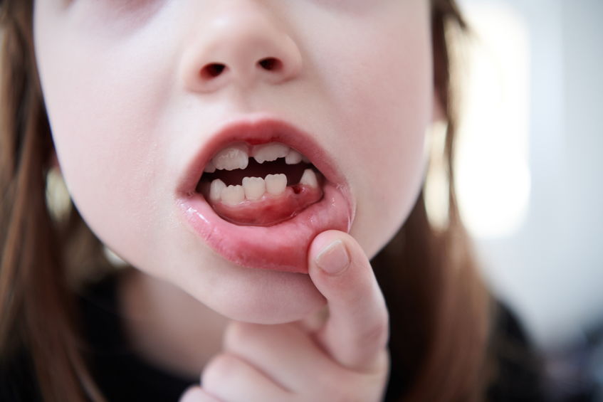 Criança com boca aberta e dente nascendo