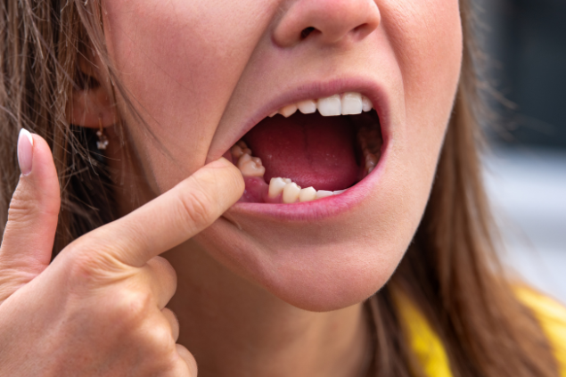 Pessoa com dente extraído 