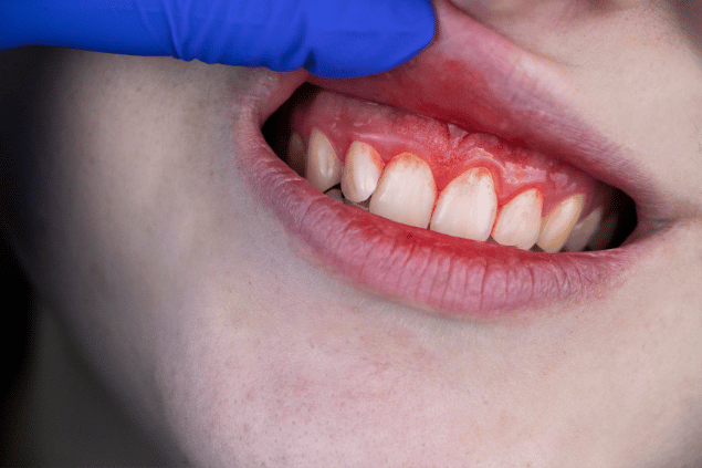 Sangue no meio dos dentes da frente