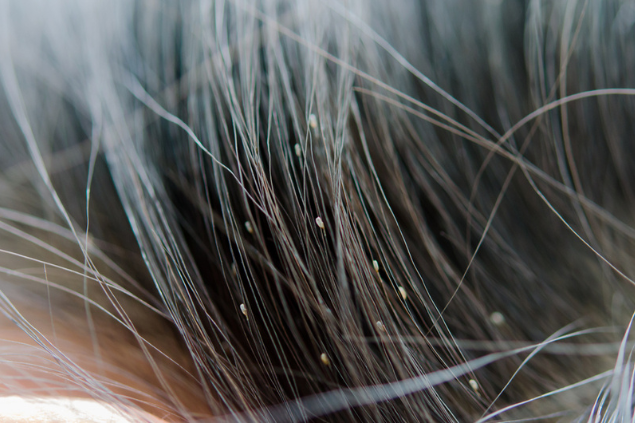 Piolhos nos fios de cabelo
