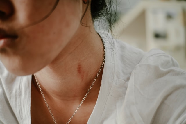 Mulher branca com inflamação no pescoço.